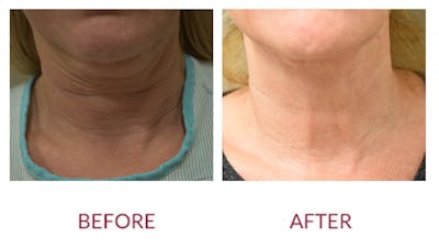Facelift Before & After Gallery - Patient 141136284 - Image 2