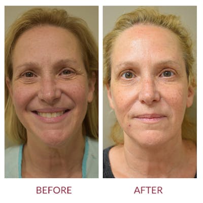 Facelift Before & After Gallery - Patient 141136284 - Image 1