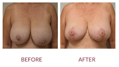 Breast Reconstruction Before & After Gallery - Patient 141136381 - Image 1