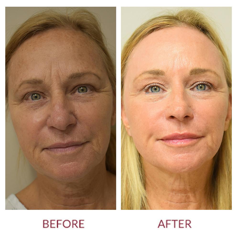 Cheek Lift Before & After Gallery - Patient 141136588 - Image 1