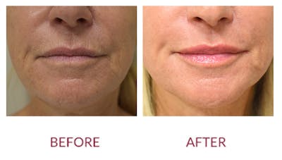 Co2 Laser Resurfacing Before & After Gallery - Patient 141136582 - Image 2
