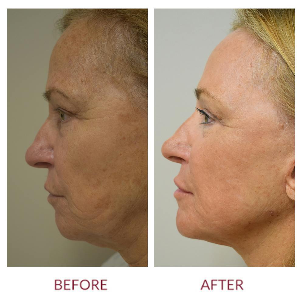 Cheek Lift Before & After Gallery - Patient 141136588 - Image 2
