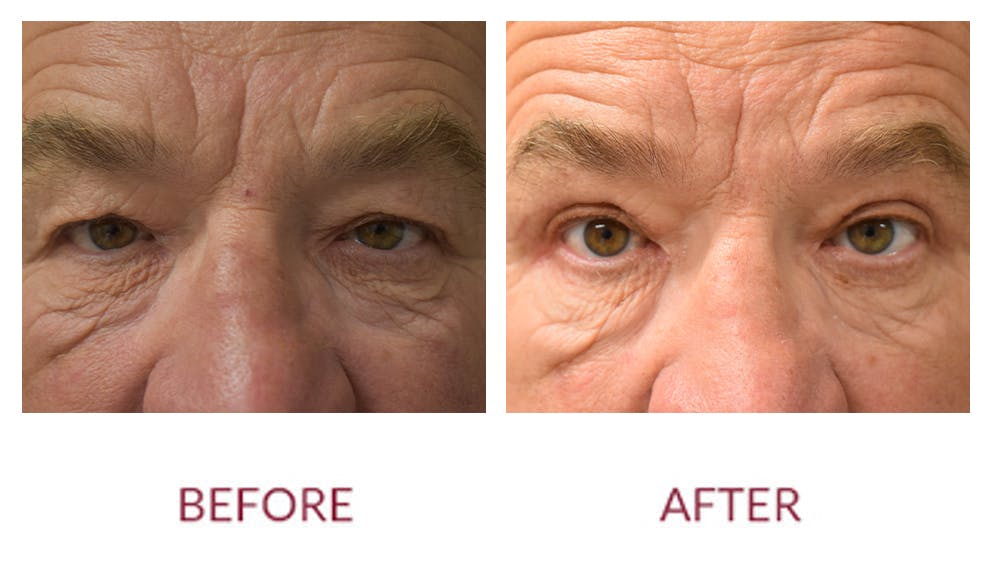Eyelid Surgery Before & After Gallery - Patient 141136647 - Image 1