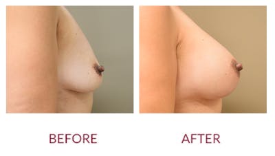 Breast Augmentation Gallery - Patient 141136665 - Image 2
