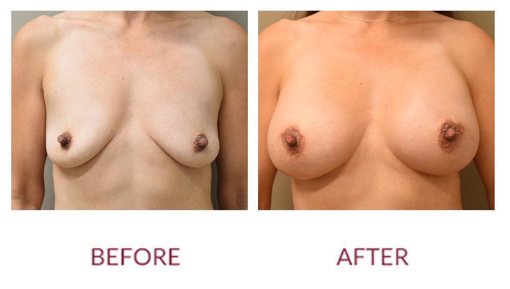 Breast Augmentation Before & After Gallery - Patient 141136665 - Image 1