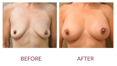 Breast Augmentation Before & After Gallery - Patient 141136665 - Image 1
