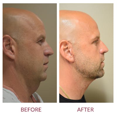 Facelift Before & After Gallery - Patient 141137175 - Image 2