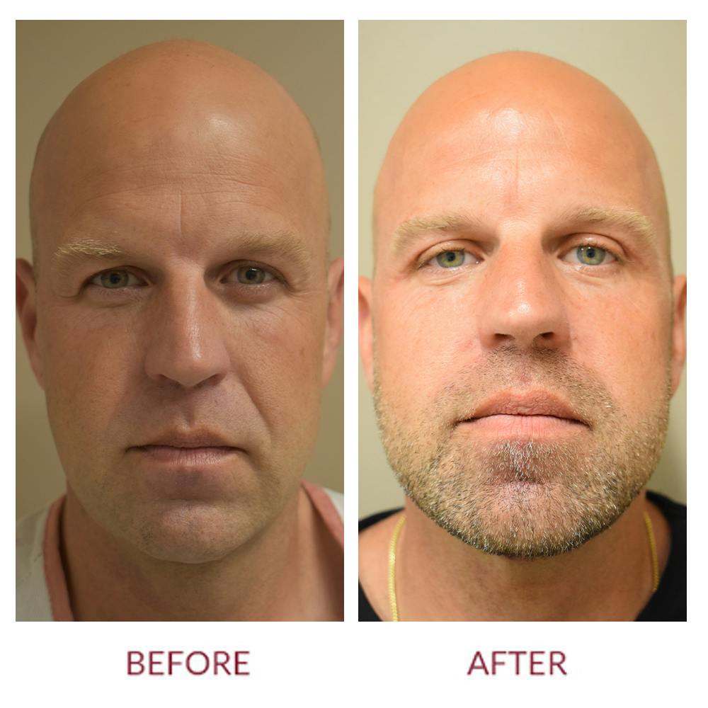 Facelift Before & After Gallery - Patient 141137175 - Image 1