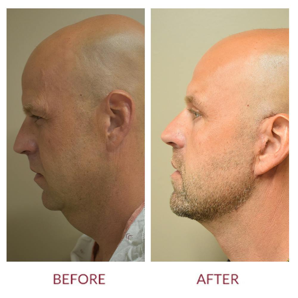 Facelift Before & After Gallery - Patient 141137175 - Image 3