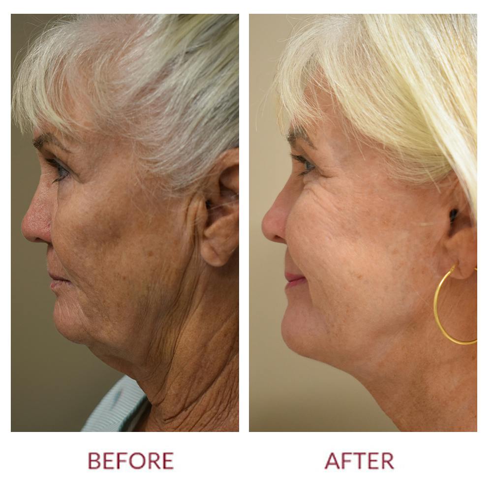 Facelift Before & After Gallery - Patient 141137215 - Image 2