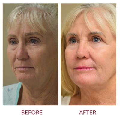 Facelift Before & After Gallery - Patient 141137215 - Image 1