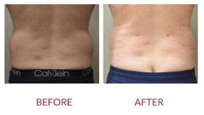 Liposuction Before & After Gallery - Patient 141137247 - Image 1