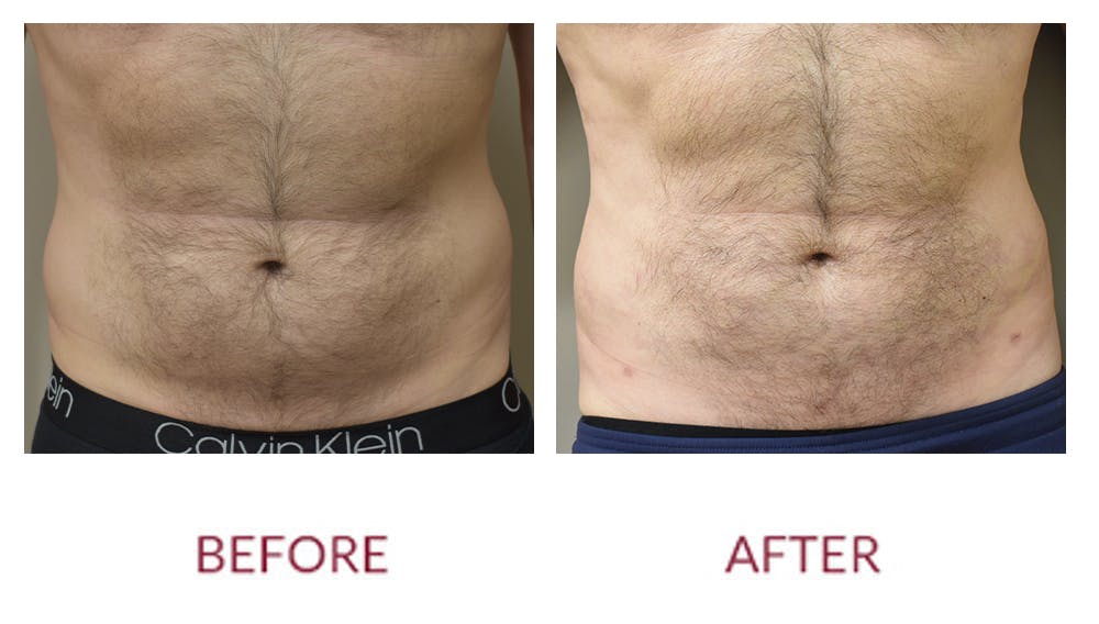 Liposuction Before & After Gallery - Patient 141137247 - Image 2