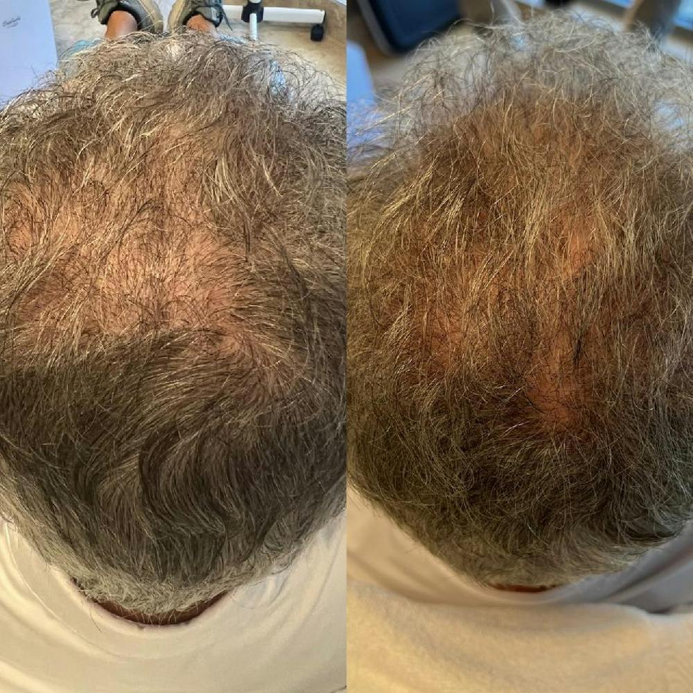 Hair Restoration Before & After Gallery - Patient 141758161 - Image 1