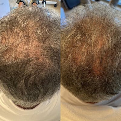 Hair Restoration Before & After Gallery - Patient 141758161 - Image 1