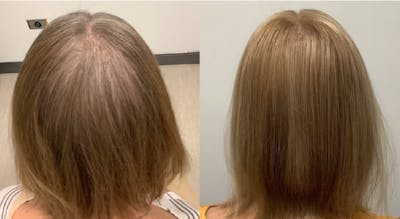 Alma TED Before & After Gallery - Patient 144239053 - Image 1