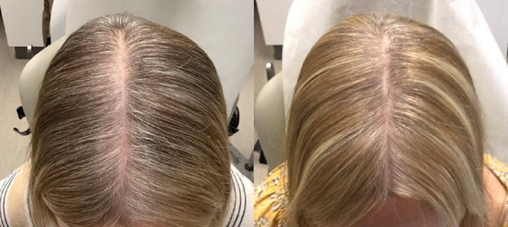 Alma TED Before & After Gallery - Patient 144239054 - Image 1