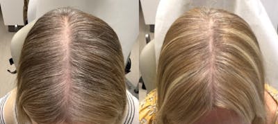 Alma TED Before & After Gallery - Patient 144239054 - Image 1