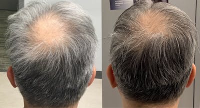 Alma TED Before & After Gallery - Patient 144239055 - Image 1