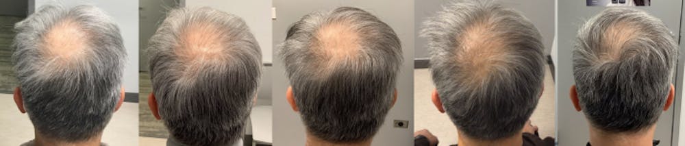 Alma TED Before & After Gallery - Patient 144239056 - Image 1