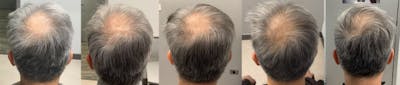 Alma TED Before & After Gallery - Patient 144239056 - Image 1