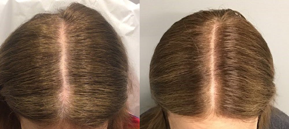 Alma TED Before & After Gallery - Patient 144239058 - Image 1