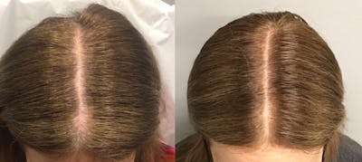 Alma TED Before & After Gallery - Patient 144239058 - Image 1