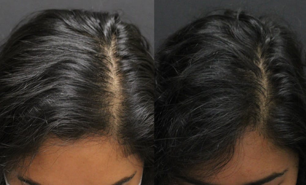 Alma TED Before & After Gallery - Patient 144239059 - Image 1