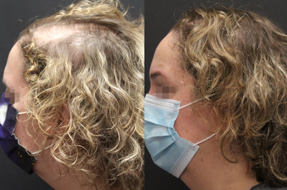 Alma TED Before & After Gallery - Patient 144239060 - Image 1