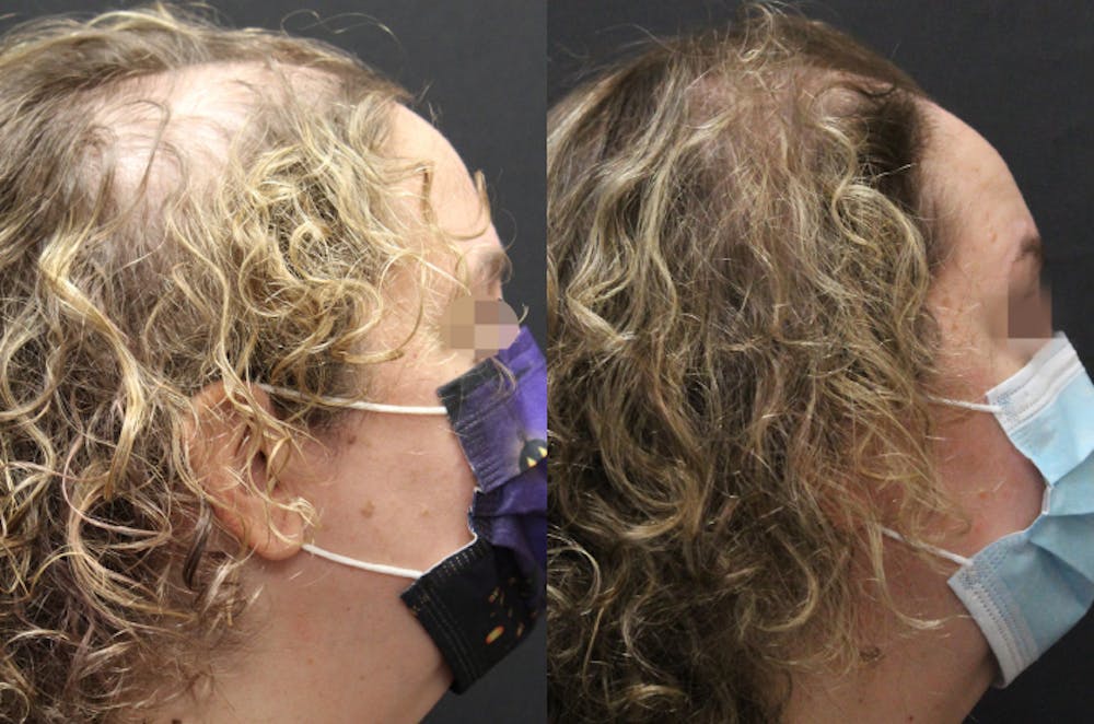 Alma TED Before & After Gallery - Patient 144239061 - Image 1