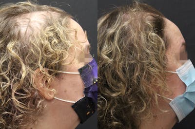 Alma TED Before & After Gallery - Patient 144239061 - Image 1