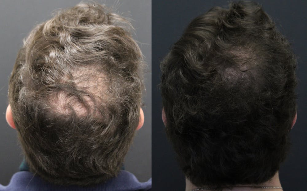 Alma TED Before & After Gallery - Patient 144239062 - Image 1