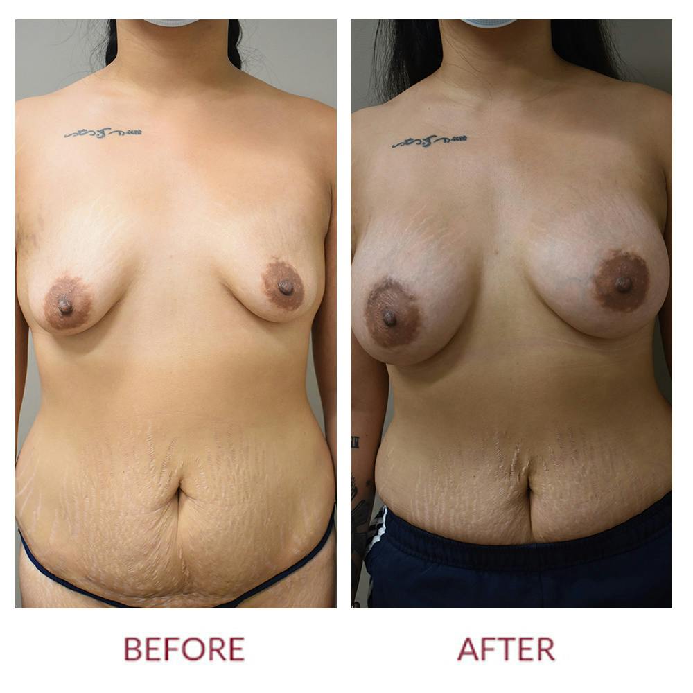 Breast Augmentation Before & After Gallery - Patient 147105253 - Image 1