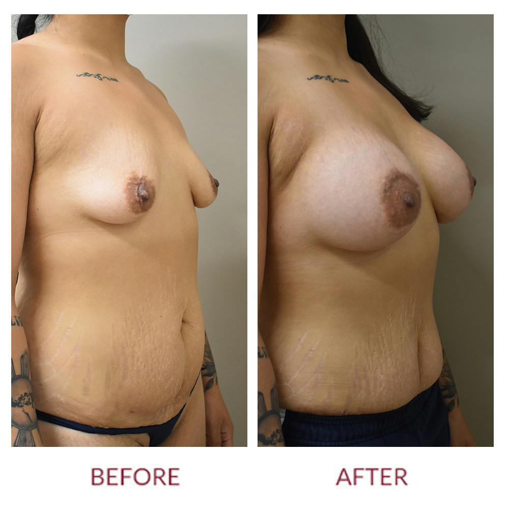 Breast Augmentation Before & After Gallery - Patient 147105253 - Image 2