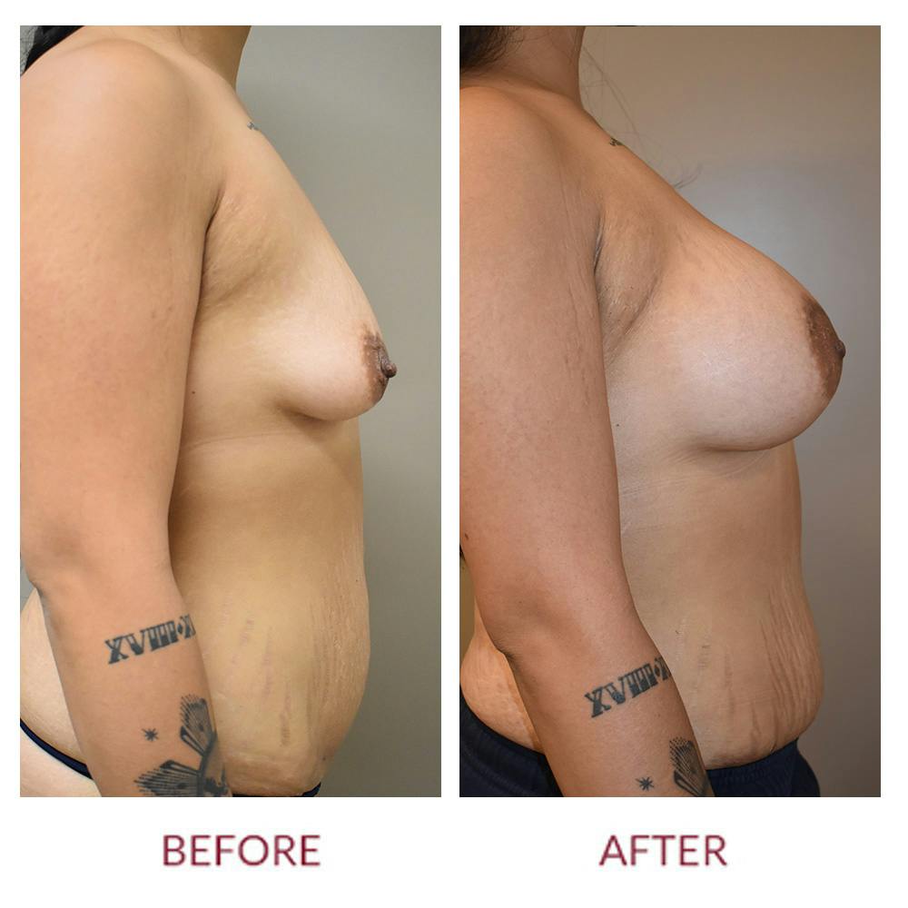 Breast Augmentation Before & After Gallery - Patient 147105253 - Image 3