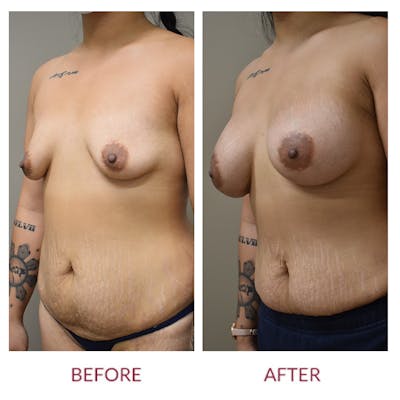 Breast Augmentation Before & After Gallery - Patient 147105253 - Image 4