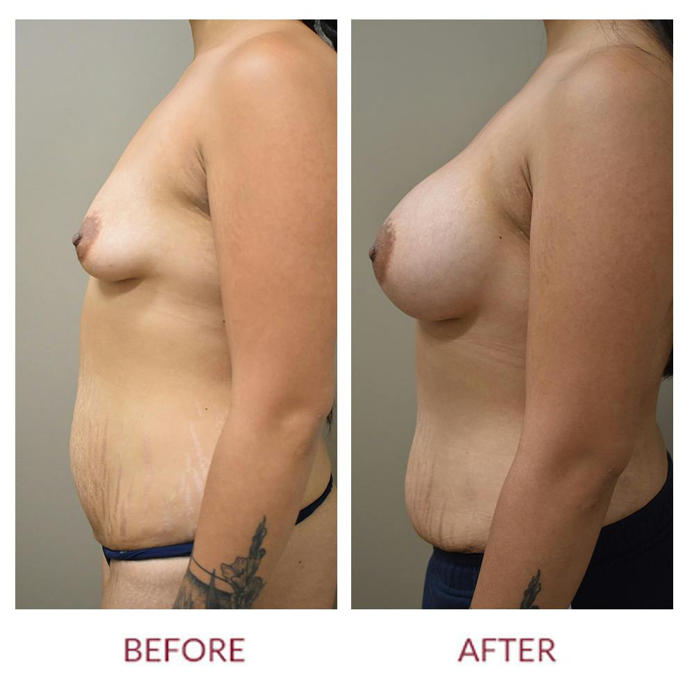 Breast Augmentation Before & After Gallery - Patient 147105253 - Image 5