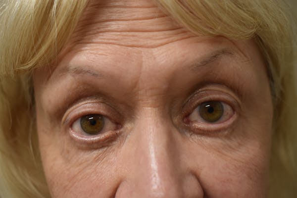Eyelid Surgery Before & After Gallery - Patient 147124213 - Image 1