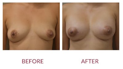 Breast Augmentation Before & After Gallery - Patient 148429646 - Image 1