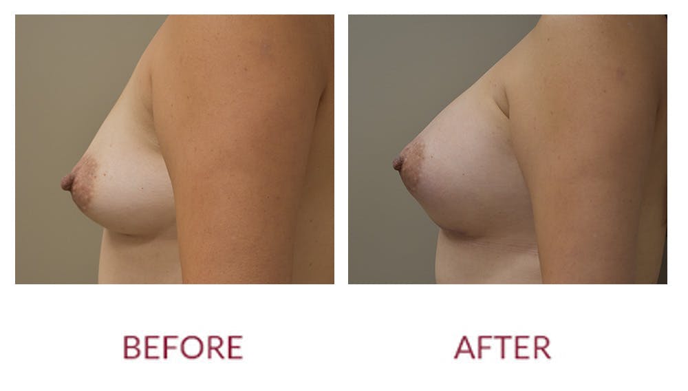 Breast Augmentation Before & After Gallery - Patient 148429646 - Image 3