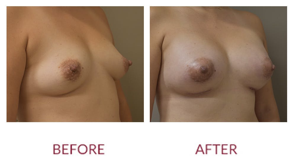 Breast Augmentation Before & After Gallery - Patient 148429646 - Image 2