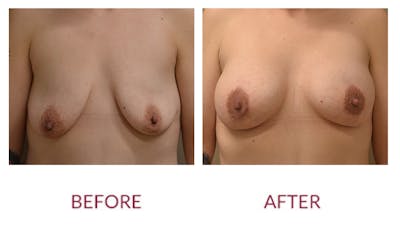 Breast Augmentation Before & After Gallery - Patient 148429645 - Image 1