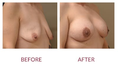 Breast Augmentation Before & After Gallery - Patient 148429645 - Image 2