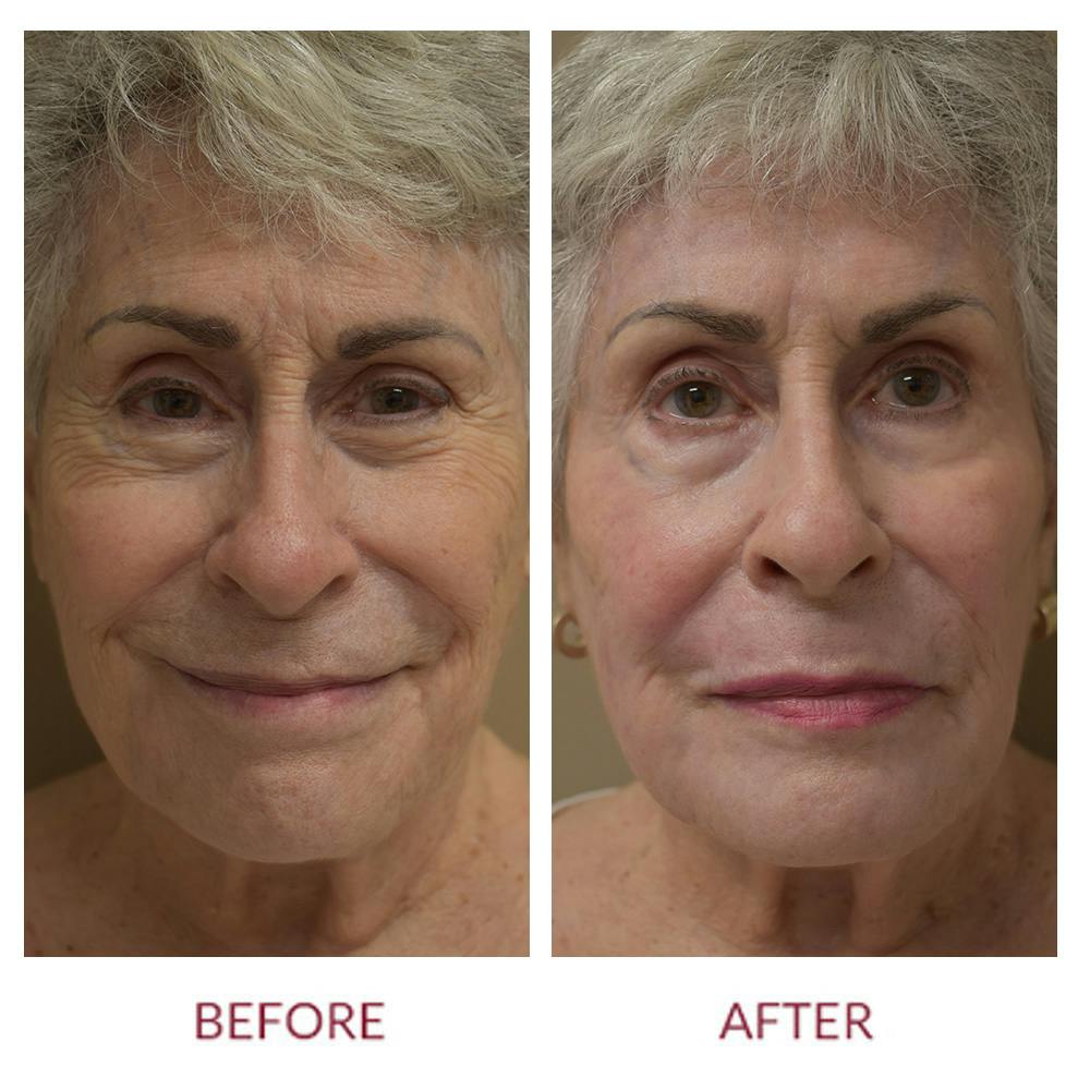 Co2 Laser Resurfacing Before & After Gallery - Patient 148429699 - Image 1