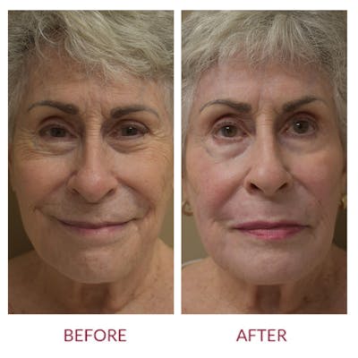 Co2 Laser Resurfacing Before & After Gallery - Patient 148429699 - Image 1