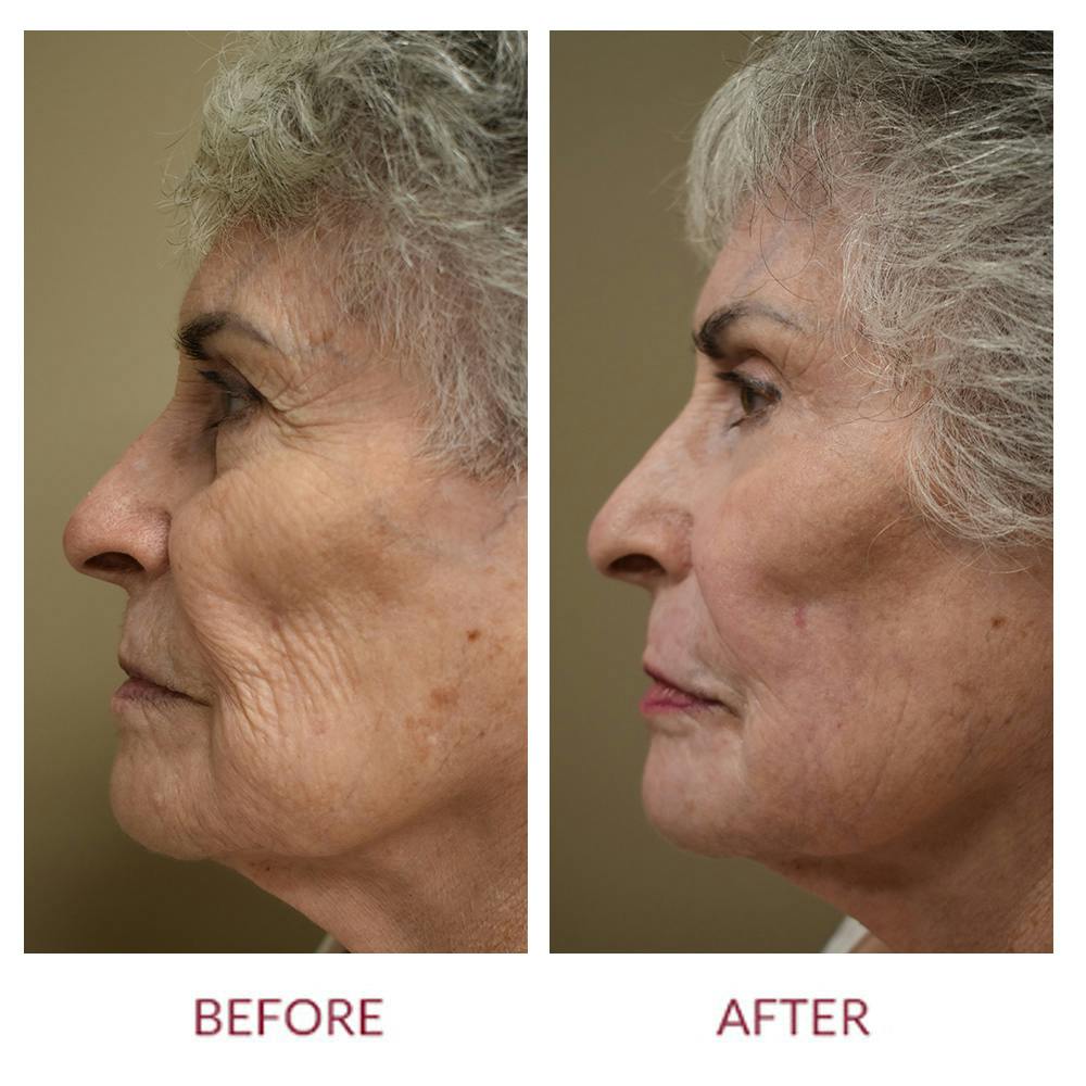 Co2 Laser Resurfacing Before & After Gallery - Patient 148429699 - Image 3