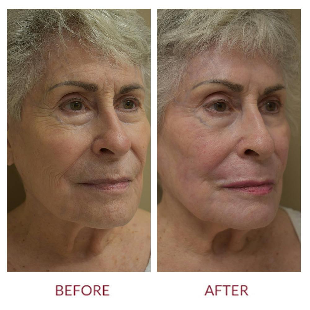 Co2 Laser Resurfacing Before & After Gallery - Patient 148429699 - Image 2
