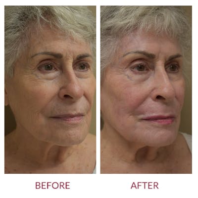 Co2 Laser Resurfacing Before & After Gallery - Patient 148429699 - Image 2