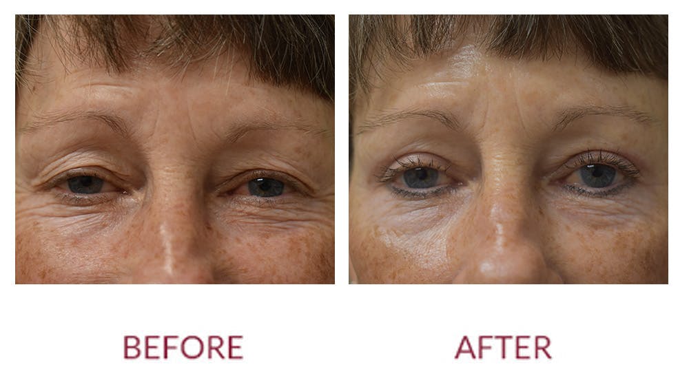 Eyelid Surgery Before & After Gallery - Patient 148429682 - Image 1