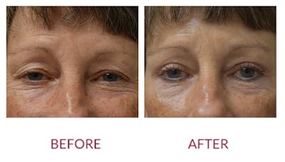 Eyelid Surgery Before & After Gallery - Patient 148429682 - Image 1